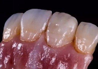 ドイツのアマンジルバッハジルコニア 歯冠 高密度 パーソナライズ